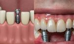 Dental Implants Explained: Everything You Need to Know